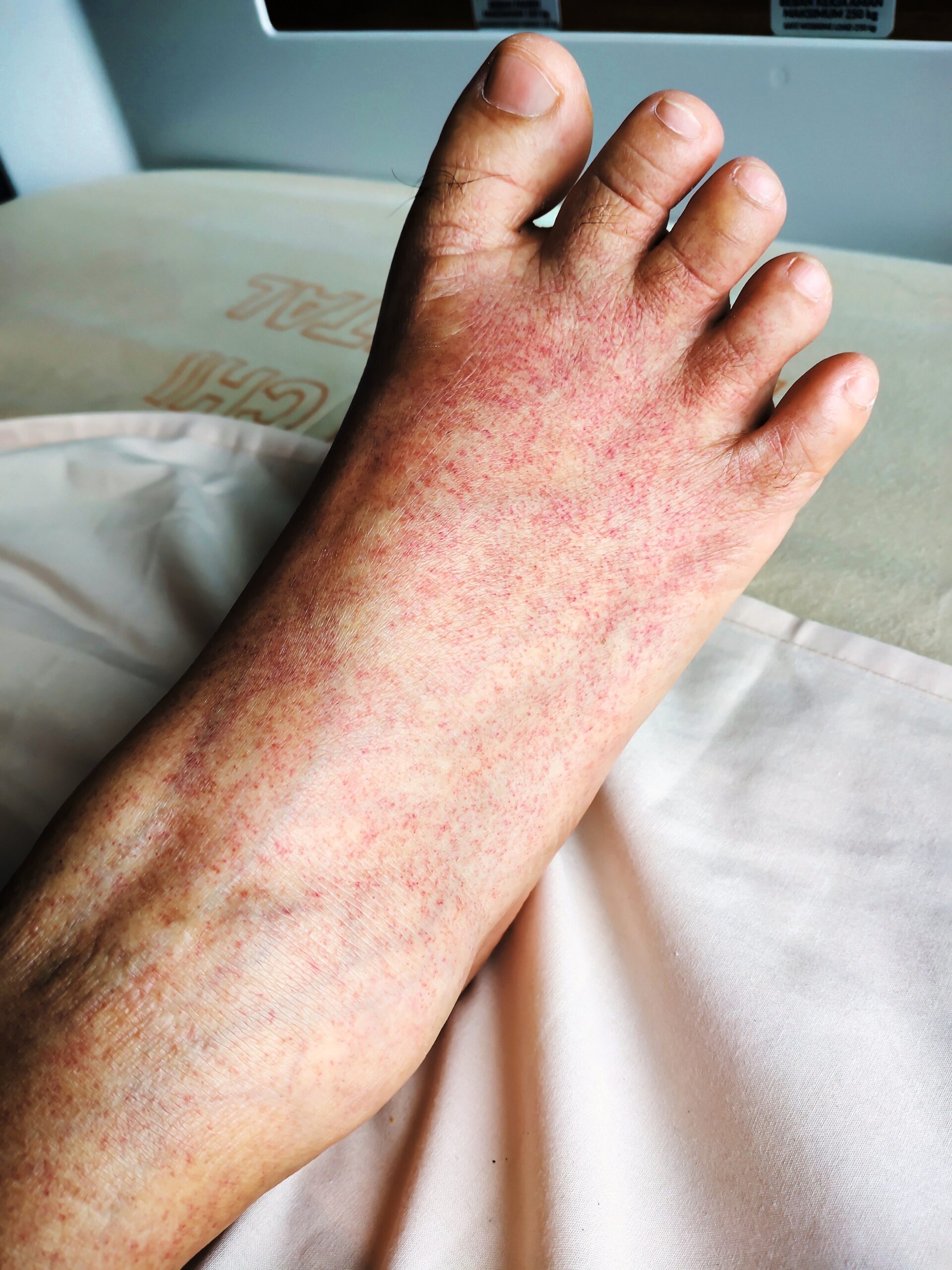 Rilzabrutinib: Neue Therapieoption bei Immunthrombozytopenie