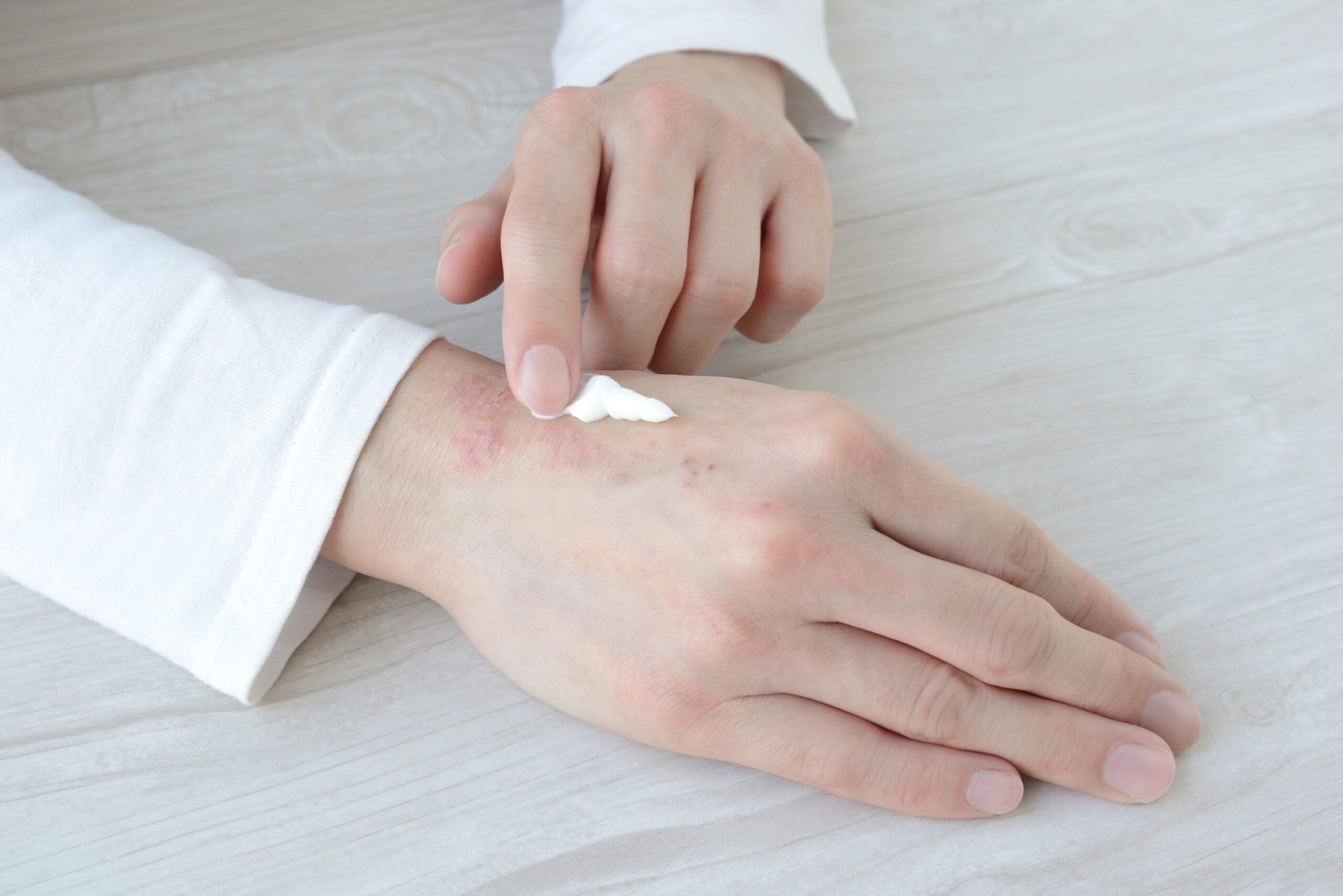 USA: Difamilast als neue Option bei Neurodermitis