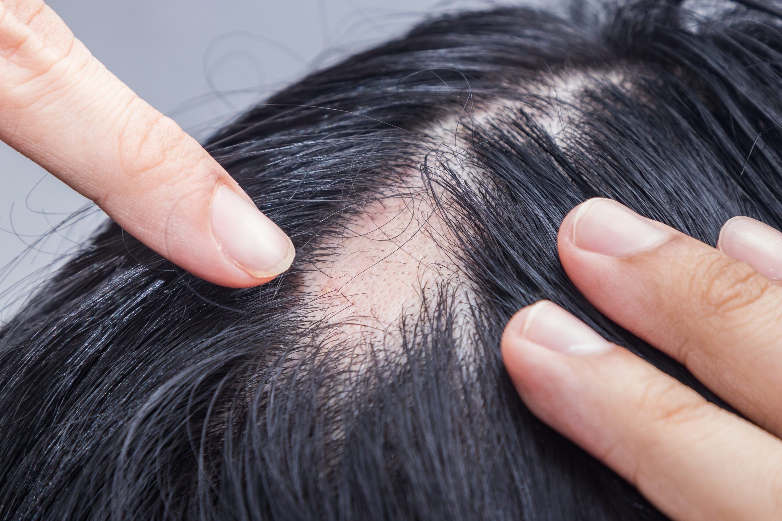 Upadacitinib erhält Zulassung bei Alopecia areata